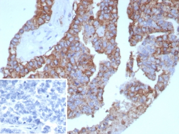 IHC staining of FFPE human ovarian cancer tissue with Pan-HLA antibody (clone rHLA-Pan/8847). Inset: PBS instead of primary, secondary negative control.~