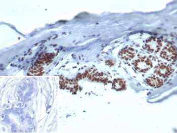 IHC staining of FFPE human breast carcinoma tissue with Heat shock 70 kDa protein 1B antibody (clone HSPA1B/7626). Inset: PBS used in place of primary Ab (secondary Ab negative control). HIER: boil tissue sections in pH 9 10mM Tris with 1mM EDTA for 20 min and allow to cool before testing.~