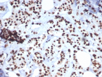 IHC staining of FFPE human breast carcinoma tissue with Heat shock 70 kDa protein 1B antibody (clone HSPA1B/7627). HIER: boil tissue sections in pH 9 10mM Tris with 1mM EDTA for 20 min and allow to cool before testing.~