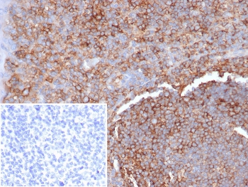 IHC staining of FFPE human tonsil tissue with HLA-G antibody (clone HLAG/7094). Inset: PBS used in place of primary Ab (secondary Ab negative control). HIER: boil tissue sections in pH 9 10mM Tris with 1mM EDTA for 20 min and allow to cool before testing.~