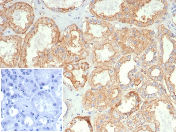 IHC staining of FFPE human kidney carcinoma tissue with HLA-G antibody (clone HLAG/7095). Inset: PBS used in place of primary Ab (secondary Ab negative control). HIER: boil tissue sections in pH 9 10mM Tris with 1mM EDTA for 20 min and allow to cool before testing.~