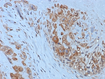 IHC staining of FFPE human placental tissue with HLA-G antibody (clone HLAG/8393R). HIER: boil tissue sections in pH 9 10mM Tris with 1mM EDTA for 20 min and allow to cool before testing.~