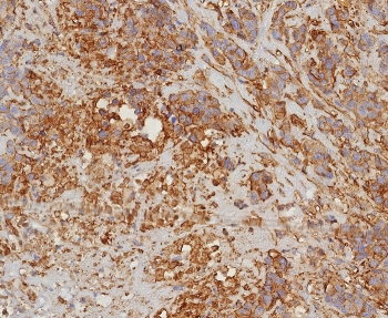 IHC staining of FFPE human bladder carcinoma with HLA-G antibody (clone HLAG/8344R). HIER: boil tissue sections in pH 9 10mM Tris with 1mM EDTA for 20 min and allow to cool before testing.~