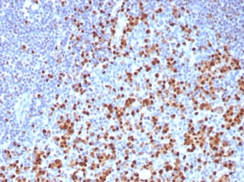IHC staining of FFPE human tonsil tissue with IRF4 antibody (clone MUM1/8274R). HIER: boil tissue sections in pH 9 10mM Tris with 1mM EDTA for 20 min and allow to cool before testing.~