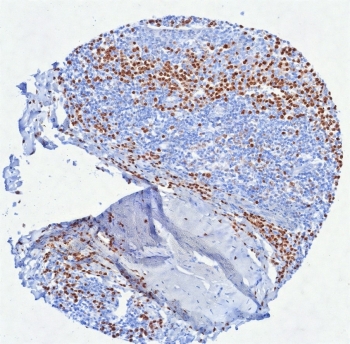 IHC staining of FFPE human tonsil tissue with Interferon regulatory factor 4 antibody (clone MUM1/8560R). HIER: boil tissue sections in pH 9 10mM Tris with 1mM EDTA for 20 min and allow to cool before testing.~