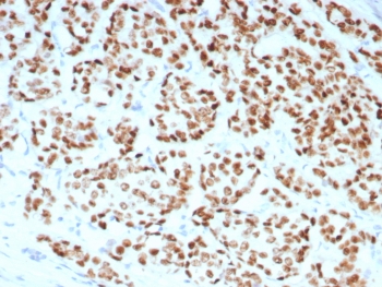 IHC staining of FFPE human breast carcinoma tissue with Estrogen Receptor alpha antibody (clone rESR1/8761). HIER: boil tissue sections in pH 9 10mM Tris with 1mM EDTA for 20 min and allow to cool before testing.~