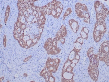 IHC staining of FFPE human lung carcinoma tissue with ROS1 antibody (clone ROS1/7999R). HIER: boil tissue sections in pH 9 10mM Tris with 1mM EDTA for 20 min and allow to cool before testing.~