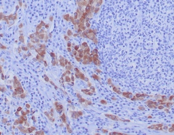 IHC staining of FFPE human lung carcinoma tiss