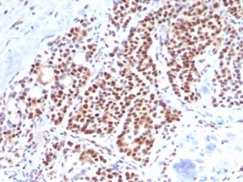 IHC staining of FFPE human parathyroid tissue with TBXT antibody (clone TBXT/7853R). HIER: boil tissue sections in pH 9 10mM Tris with 1mM EDTA for 20 min and allow to cool before testing.~