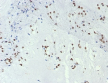 IHC staining of FFPE human chordoma tissue with T