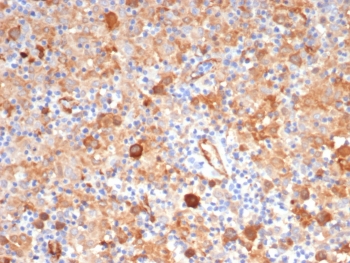 IHC staining of FFPE human Hodgkin's lymphoma tissue with Fascin 1 antibody (clone FSCN1/7207) at 2ug/ml. HIER: boil tissue sections in pH 9 10mM Tris with 1mM EDTA for 20 min and allow to cool before testing.~