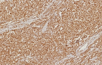 IHC staining of FFPE human colon carcinoma tissue with PMS2 antibody (clone PMS2/8374R). HIER: boil tissue sections in pH 9 10mM Tris with 1mM EDTA for 20 min and allow to cool before testing.~
