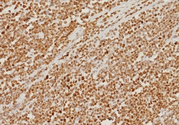 IHC staining of FFPE human colon carcinoma ti