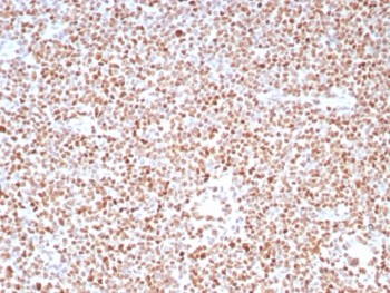 IHC staining of FFPE human colon carcinoma tissue with PMS2 antibody (clone PMS2/8224R). HIER: boil tissue sections in pH 9 10mM Tris with 1mM EDTA for 20 min and allow to cool before testing.~