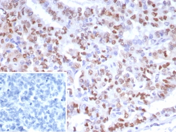 IHC staining of FFPE human ovarian cancer tis