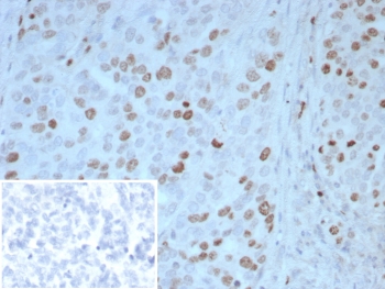 IHC staining of FFPE human ovarian carcinoma tissue with PAX4 antibody (clone PAX4/7598). Inset: PBS used in place of primary Ab (secondary Ab negative control). HIER: boil tissue sections in pH 9 10mM Tris with 1mM EDTA for 20 min and allow to cool before testing.~
