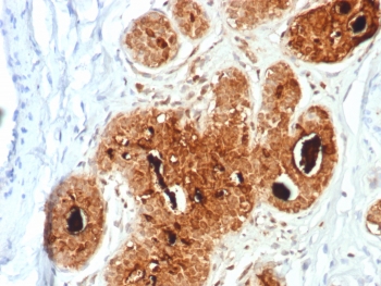 IHC staining of FFPE human breast carcinoma tissue with Prolactin-Induced Protein antibody (clone PIP/7477). HIER: boil tissue sections in pH 9 10mM Tris with 1mM EDTA for 20 min and allow to cool before testing.~