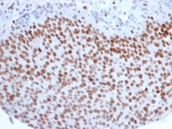 IHC staining of FFPE human bladder carcinoma with Enhancer of zeste homolog 2 antibody (clone EZH2/6988). HIER: boil tissue sections in pH 9 10mM Tris with 1mM EDTA for 20 min and allow to cool before testing.~