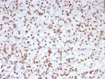IHC staining of FFPE human renal cell carcinoma tissue with EZH2 antibody (clone EZH2/7507). HIER: boil tissue sections in pH 9 10mM Tris with 1mM EDTA for 20 min and allow to cool before testing.~