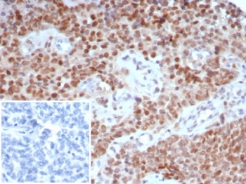 IHC staining of FFPE human ovary tissue with TRPS1 antibody (clone TRPS1/7912R). Inset: PBS used in place of primary Ab (secondary Ab negative control). HIER: boil tissue sections in pH 9 10mM Tris with 1mM EDTA for 20 min and allow to cool before testing.~