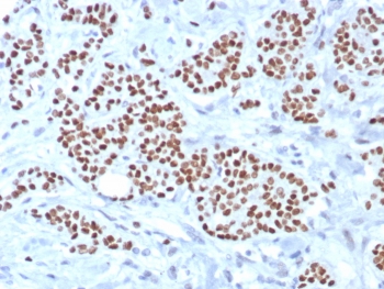IHC staining of FFPE human breast carcinoma tissue with TRPS1 antibody (clone TRPS1/8008R). HIER: boil tissue sections in pH 9 10mM Tris with 1mM EDTA for 20 min and allow to cool before testing.