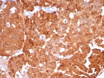 IHC staining of FFPE human ovarian carcinoma tissue with P16INK4a antibody (clone CDKN2A/8223R). HIER: boil tissue sections in pH 9 10mM Tris with 1mM EDTA for 20 min and allow to cool before testing.~