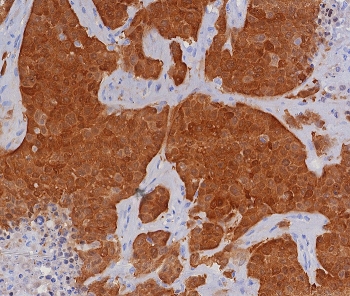 IHC staining of FFPE human bladder carcinoma tissue with P16INK4a antibody (clone CDKN2A/8196R). HIER: boil tissue sections in pH 9 10mM Tris with 1mM EDTA for 20 min and allow to cool before testing.~