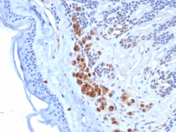 IHC staining of FFPE human melanoma tissue with Tyrosinase-Related Protein-1 antibody (clone TYRP1/8313R). HIER: boil tissue sections in pH 9 10mM Tris with 1mM EDTA for 20 min and allow to cool before testing.~