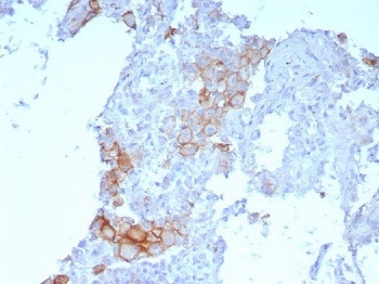 IHC staining of FFPE human lung SqCC with Programmed cell death 1 ligand 1 antibody (clone PDL1/7568R). HIER: boil tissue sections in pH 9 10mM Tris with 1mM EDTA for 20 min and allow to cool before testing.~