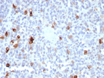 IHC staining of FFPE human melanoma tissue with Melan-A antibody (clone MLANA/8365R). HIER: boil tissue sections in pH 9 10mM Tris with 1mM EDTA for 20 min and allow to cool before testing.~