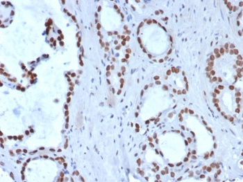 IHC staining of FFPE human prostate carcinoma tissue with Transducin-like enhancer protein 1 antibody (clone TLE1/8007R). HIER: boil tissue sections in pH 9 10mM Tris with 1mM EDTA for 20 min and allow to cool before testing.~