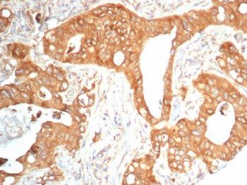 IHC staining of FFPE human colon carcinoma tissue with TrkB antibody (clone NTRK2/4673). HIER: boil tissue sections in pH 9 10mM Tris with 1mM EDTA for 20 min and allow to cool before testing.~