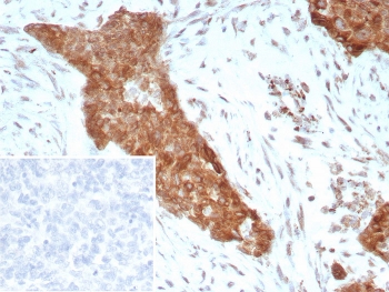 IHC staining of FFPE human ovarian cancer tissue with Tropomyosin-related kinase B antibody (clone NTRK2/7926). Inset: PBS used in place of primary Ab (secondary Ab negative control). HIER: boil tissue sections in pH 9 10mM Tris with 1mM EDTA for 20 min and allow to cool before testing.~