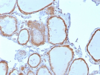 IHC staining of FFPE human thyroid tissue with TrkB antibody (clone NTRK2/7928). HIER: boil tissue sections in pH 9 10mM Tris with 1mM EDTA for 20 min and allow to cool before testing.~