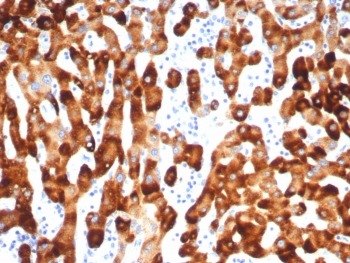 IHC staining of FFPE human HBV-infected liver with HBsAg antibody (clone HBsAG/7666R). HIER: boil tissue sections in pH 9 10mM Tris with 1mM EDTA for 20 min and allow to cool before testing.~
