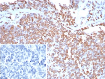 IHC staining of FFPE human ovarian cancer tissue with Double Stranded DNA antibody (clone rDSD/8266). Inset: PBS used in place of primary Ab (secondary Ab negative control). HIER: boil tissue sections in pH 9 10mM Tris with 1mM EDTA for 20 min and allow to cool before testing.~