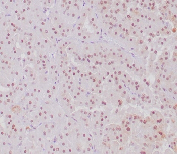 IHC staining of FFPE human MiT translocation RCC with TFE3 antibody. Nuclear staining using TFE3/6849R mAb at 2ug/ml. HIER: boil tissue sections in pH 9 10mM Tris with 1mM EDTA for 20 min and allow to cool before testing.~