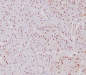 IHC staining of FFPE human MiT translocation RCC with TFE3 antibody. Nuclear staining using TFE3/6849R mAb at 2ug/ml. HIER: boil tissue sections in pH 9 10mM Tris with 1mM EDTA for 20 min and allow to cool before testing.