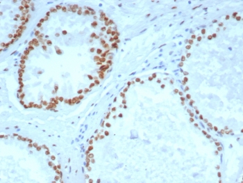 IHC staining of FFPE human prostate carcinoma tissue with Androgen Receptor antibody (clone DHTR/4929R). HIER: boil tissue sections in pH 9 10mM Tris with 1mM EDTA for 20 min and allow to cool before testing.~