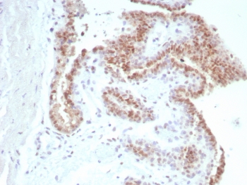 IHC staining of FFPE human prostate carcinoma tissue with Androgen Receptor antibody (clone rDHTR/8818). HIER: boil tissue sections in pH 9 10mM Tris with 1mM EDTA for 20 min and allow to cool before testing.~