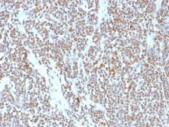 IHC staining of FFPE human colon tissue with ATRX antibody (clone ATRX/7940). HIER: boil tissue sections in pH 9 10mM Tris with 1mM EDTA for 20 min and allow to cool before testing.~