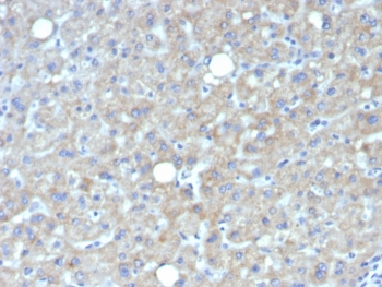 IHC staining of FFPE human hepatocellular carcinoma tissue with Glypican-3 antibody (clone GPC3/7419). HIER: boil tissue sections in pH 9 10mM Tris with 1mM EDTA for 20 min and allow to cool before testing.~