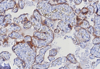 IHC staining of FFPE human hepatocellular carcinoma tissue with Glypican-3 antibody (clone GPC3/8127R). HIER: boil tissue sections in pH 9 10mM Tris with 1mM EDTA for 20 min and allow to cool before testing.~