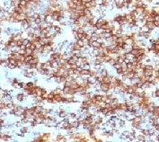IHC testing of CD45RB antibody and FFPE human lymphoma (clone CDLA45RB-1).