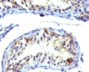 IHC analysis of Prolactin receptor antibody (clone ERSV8-1) and testicular carcinoma. Required HIER: digestion of tissue sections with pepsin at 1mg/ml in Tris-HCl, pH 2, for 15 min at RT or 10 min at 37oC.