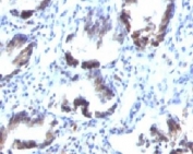 IHC testing of FFPE human colon carcinoma with SM22 alpha antibody (clone SMP22a).