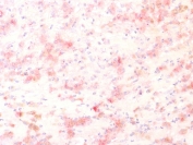 IHC testing of FFPE human melanoma with recombinant TYRP1 antibody, HRP secondary and AEC chromogen. HIER: steam sections in 10mM Tris with 1mM EDTA, pH 9.0, for 10-20 min.