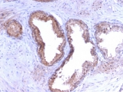 IHC staining of FFPE human prostate carcinoma with PSA antibody (clone KLK3/2871R). HIER: boil tissue sections in 10mM Tris with 1mM EDTA, pH 9 for 10-20 min and allow to cool before testing.