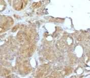 IHC staining of FFPE human breast carcinoma with recombinant MVP antibody (clone MJVP-1R). HIER: boil tissue sections in pH 9 10mM Tris with 1mM EDTA for 10-20 min and allow to cool before testing.