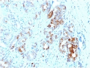 IHC testing of FFPE human prostate with FTL antibody (clone FTL/1387). HIER: boil tissue sections in 10mM citrate buffer, pH 6, for 10-20 min and allow to cool before testing.